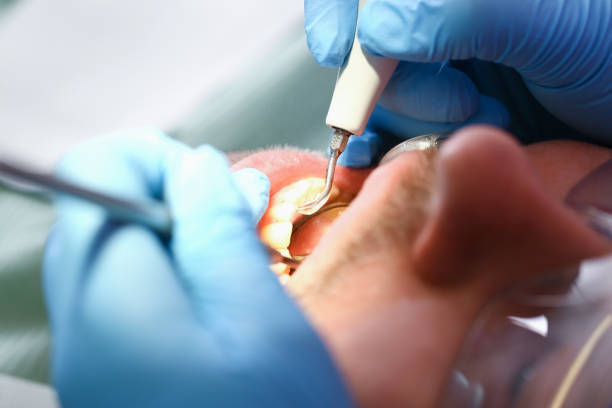 Best Emergency Root Canal Treatment in West Bradenton, FL