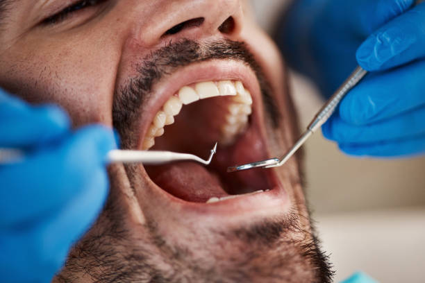 Best Urgent Care for Lost Fillings or Crowns in West Bradenton, FL